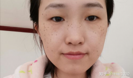 激光祛斑视频全过程,安全高效，美丽蜕变